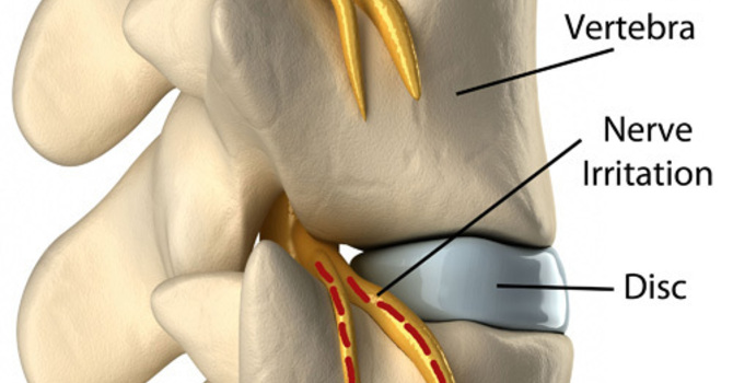 Condition of the Month – Thoracic Joint Restriction image