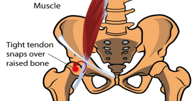 Condition of the Month – Snapping Hip image