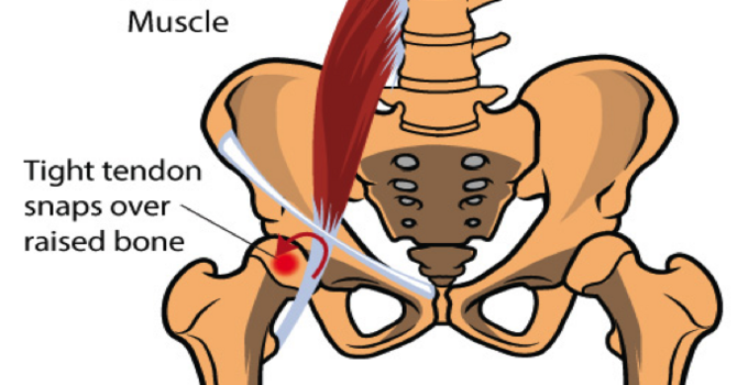 Condition of the Month – Snapping Hip image
