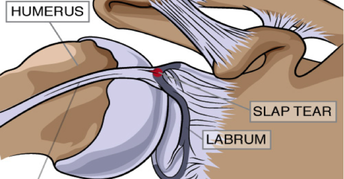 Condition of the Month – SLAP Tear image