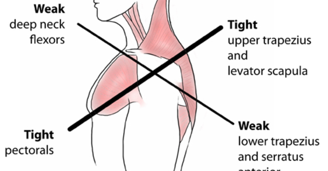 Condition of the Month – Upper Crossed Syndrome image