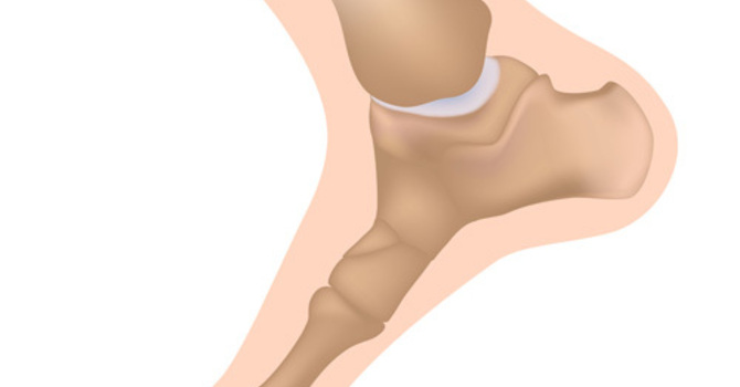 Condition of the Month – Turf Toe image