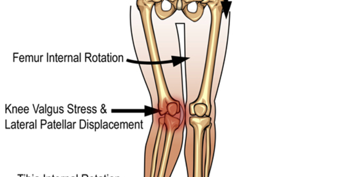 Condition of the Month – Overpronation image